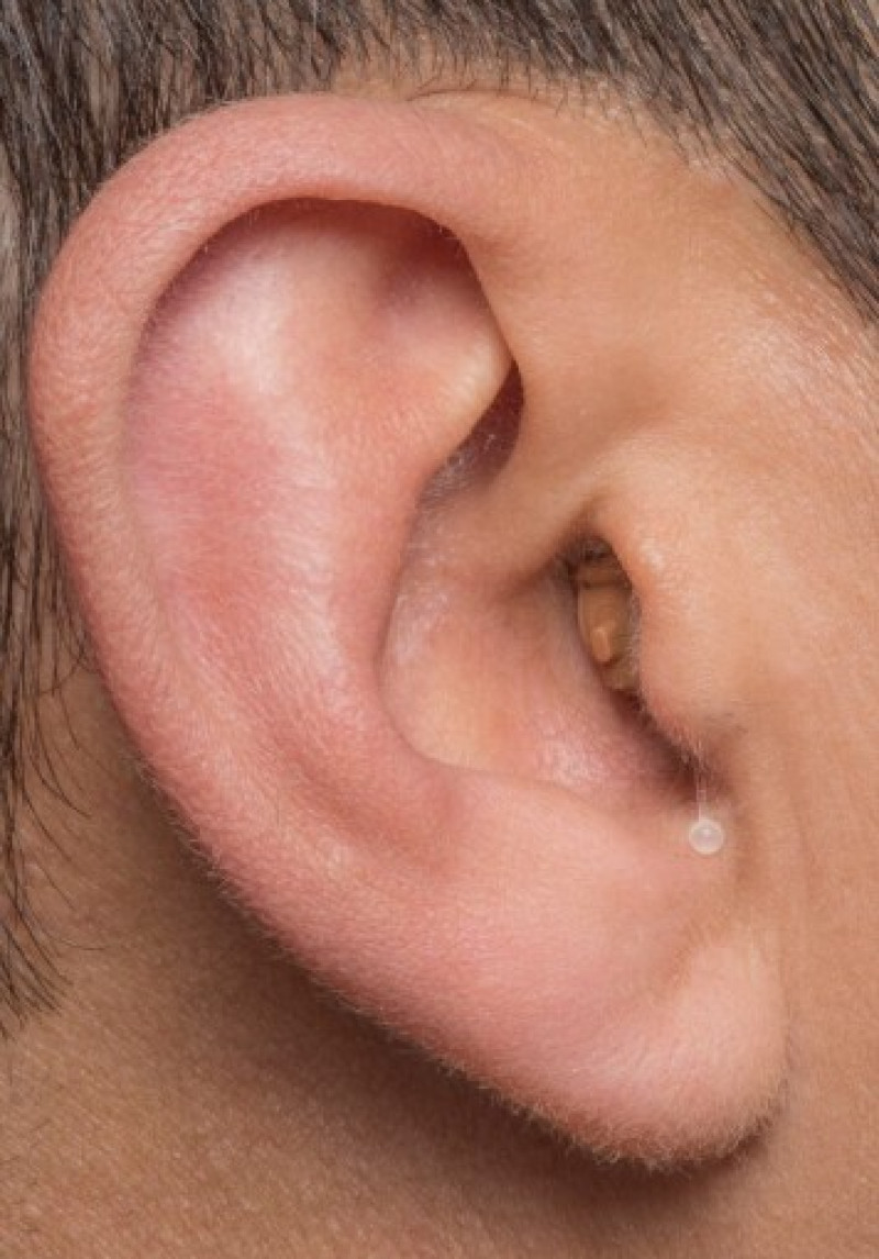 CIC hearing aid worn inside the ear canal with discreet low-profile appearance