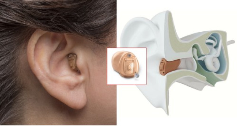 3D anatomical illustration showing deep placement of a CIC hearing aid inside the ear canal for natural sound and reduced visibility.