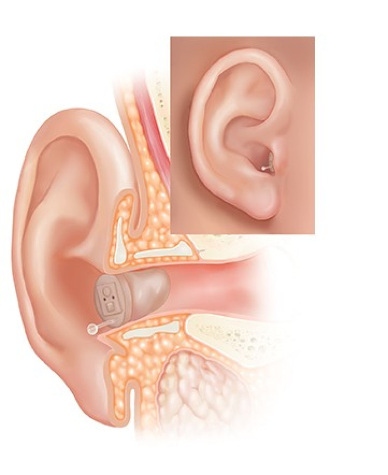 Illustration showing how a CIC hearing aid sits flush inside the ear canal for discreet and comfortable hearing correction.