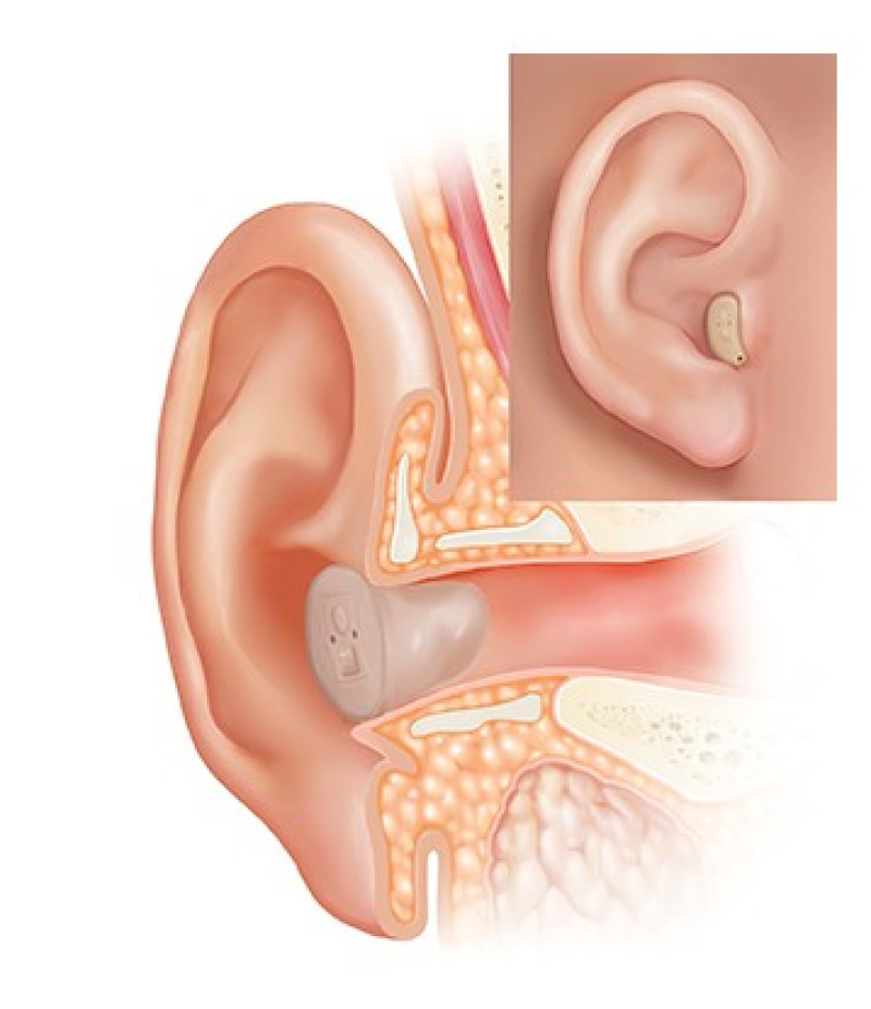 Illustration showing how ITC hearing aids fit inside and slightly outside the ear canal for secure comfort and powerful hearing performance.