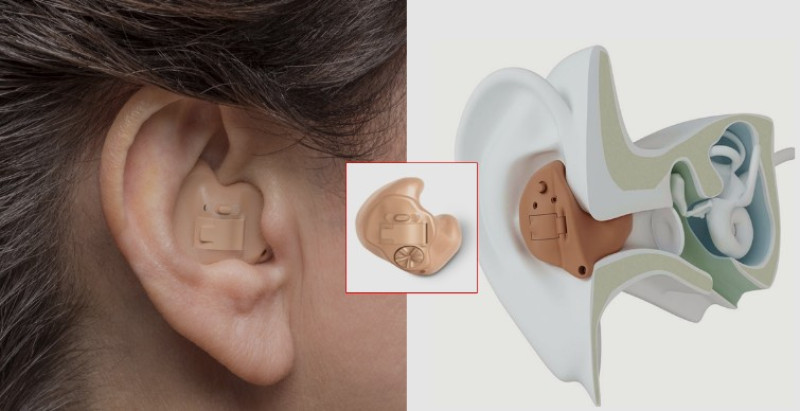 ITE hearing aid filling the outer ear bowl for secure and comfortable placement