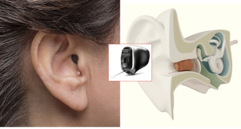 3D illustration showing deep insertion placement of IIC hearing aid inside the ear canal
