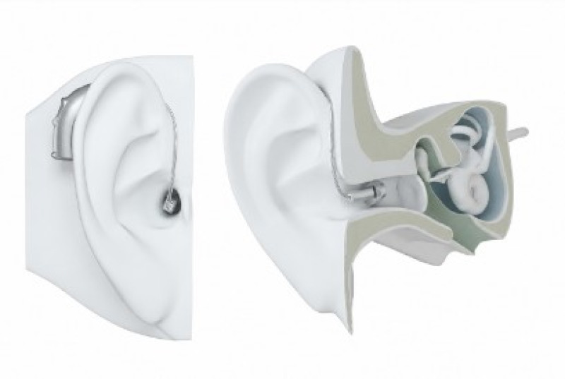 RIC hearing aid receiver positioned inside the ear canal with thin wire connection